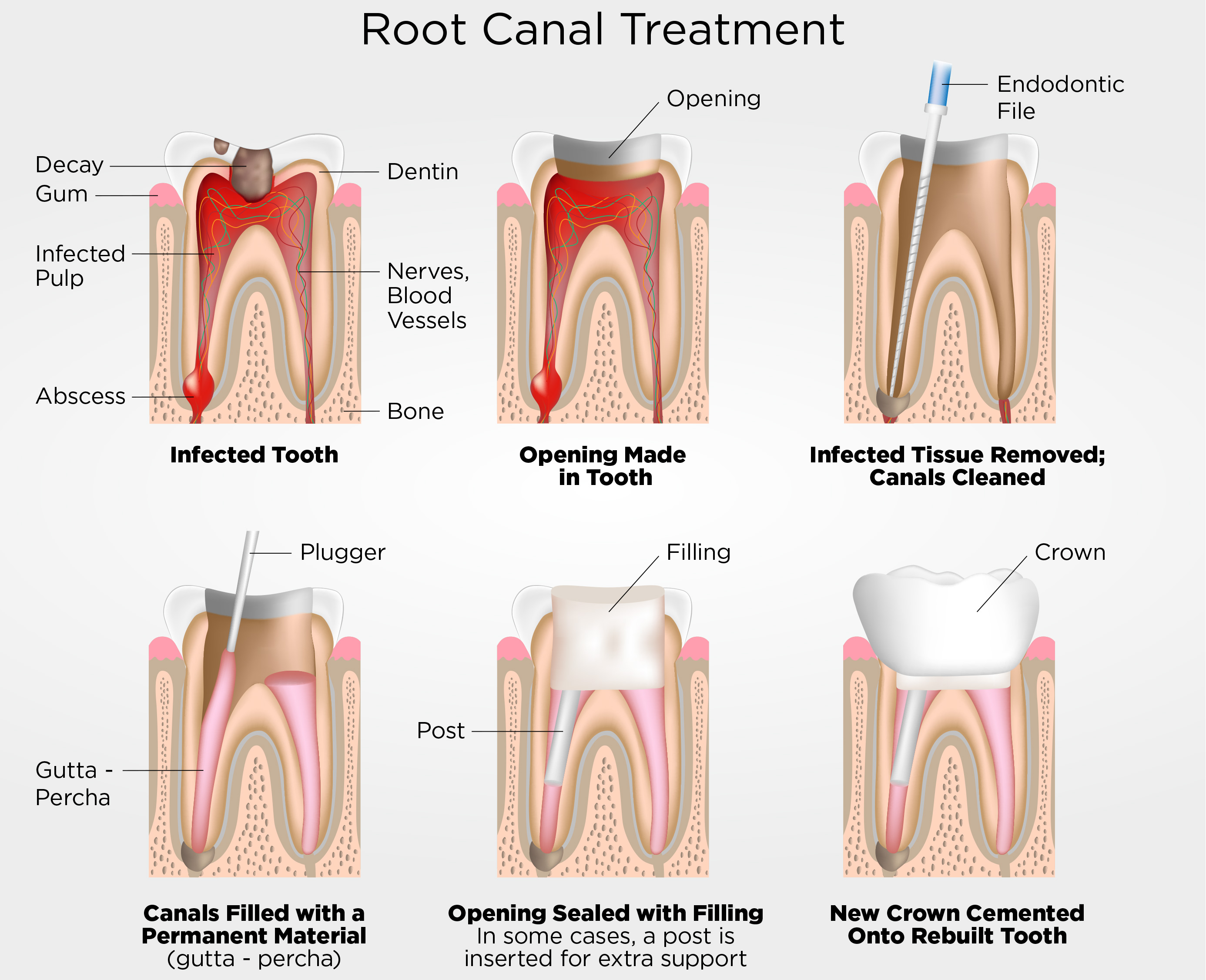 Root Canal Treatment Diagram
